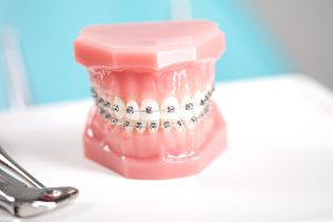 Dentaduras con braces